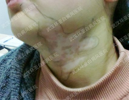 摆脱白癜风快乐女孩终圆大学梦