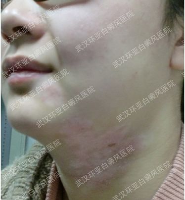 摆脱白癜风快乐女孩终圆大学梦