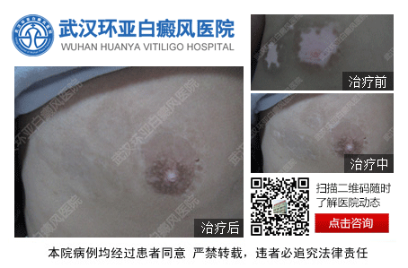 武汉白癜风治疗哪家医院比较好