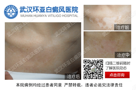 武汉哪个医院白癜风瞧的好
