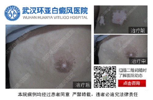 武汉环亚白癜风医院 武汉环亚白癜风医院