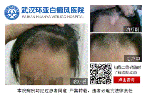 武汉环亚白癜风医院 武汉环亚白癜风医院