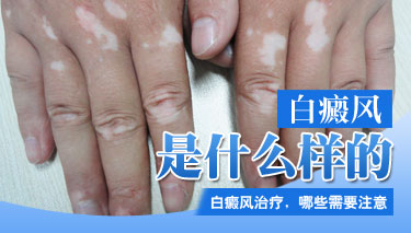 武汉环亚白癜风医院 武汉环亚白癜风医院