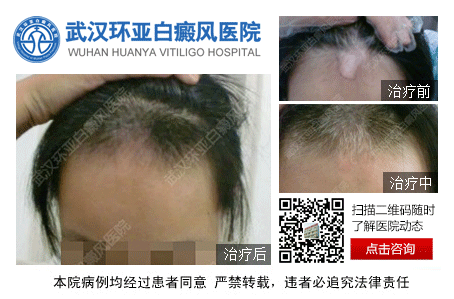 武汉白癜风哪家好