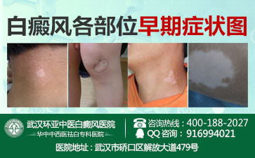 武汉哪家医院治疗白癜风