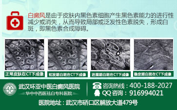 武汉哪家医院治疗白癜风比较好