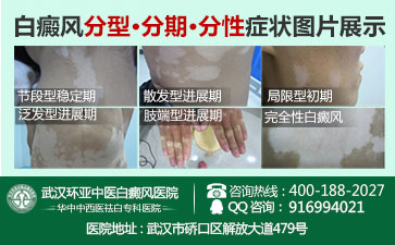 武汉哪个医院治白癜风效果好 武汉哪个医院治白癜风效果好