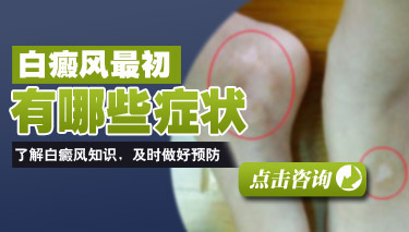 白癜风症状有什么症状特点 白癜风症状有什么症状特点
