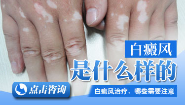 白癜风的早期症状要怎么治疗 白癜风的早期症状要怎么治疗
