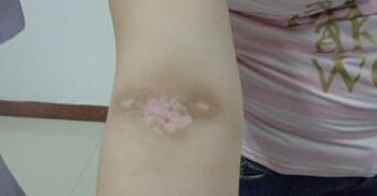 武汉哪家医院治白癜风好白殿疯是怎样引起的