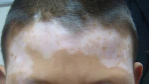 武汉白癜风白斑初期图