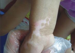 武汉小儿白癜风的原因