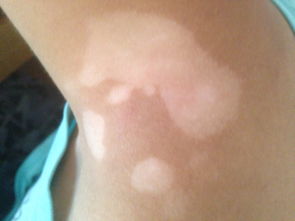 武汉白癜风原因有哪些呢