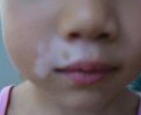 武汉白癜风病原因有哪些