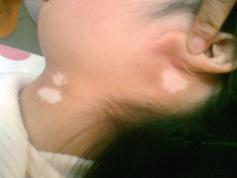 武汉白癜风发病病因有哪些