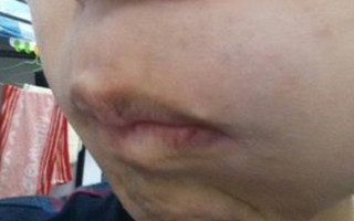 武汉白癜风的原因有什么