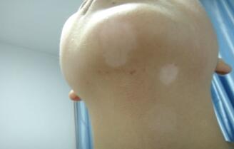 武汉治白癜风较好的医院在哪里