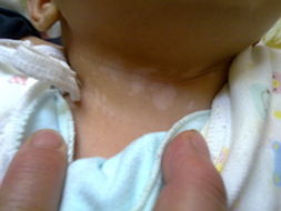 患者脸上出现白斑是哪些原因