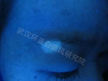 儿童白癜风治疗较好的方法是什么