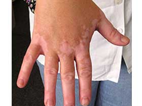 哪家医院能治白癜风呢