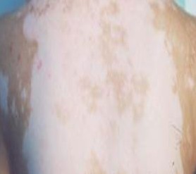 怎么能治愈白癜风该用什么药