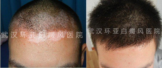 中医治疗白癜风