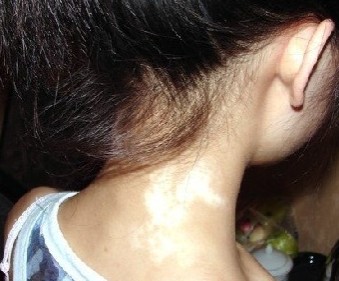 颈部白癜风怎么治疗呢