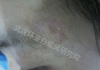 肢端型白癜风该怎么治疗呢
