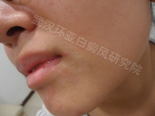 肢端型白癜风有哪些特征