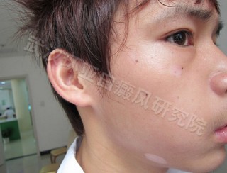 节段型白癜风该怎么保养呢