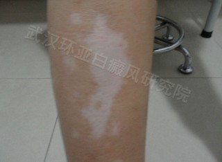 泛发型白癜风治疗要点是什么