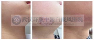 泛发型白癜风较佳治疗方法
