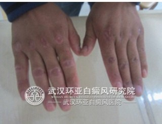 白癜风如何通过饮食调理