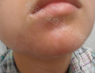 白癜风反复发作怎么办