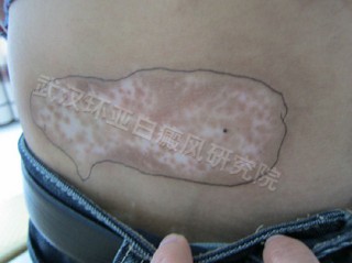 儿童患了白癜风怎么办