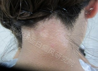 诱发白癜风的因素有什么