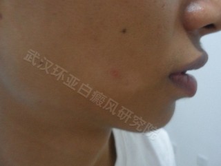 白癜风能吃西红柿吗