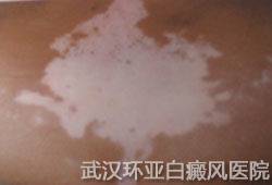 白癜风的发病原因有哪些