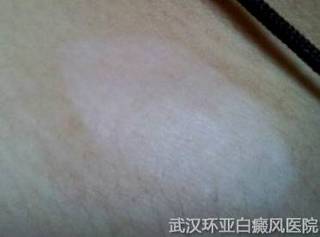 到底该怎么治疗白癜风疾病呢