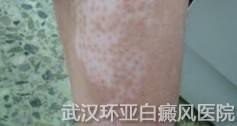 哪些外界因素会引起白癜风