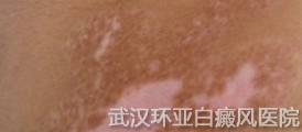 白癜风久治不愈因素表现