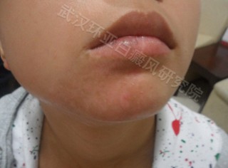 治疗白癜风的偏方哪些好