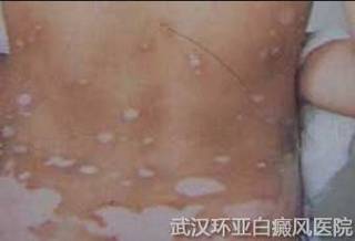 黑色素种植要多少钱