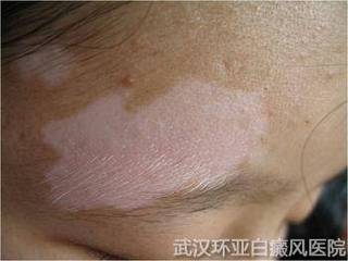 泛发型白癜风症状是什么
