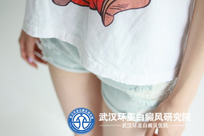 引起白癜风的主要原因究竟在哪里呢