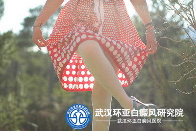 早期白癜风的白斑有哪些临床上的表现呢