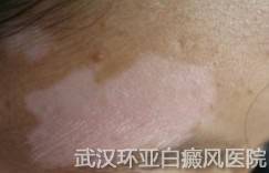 青少年患上白癜风怎么治