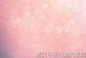 造成白癜风出现的原因有哪些