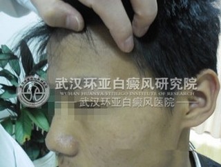 青少年白癜风的发病原因是什么