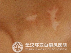 肢端型白癜风患者注意事项有哪些